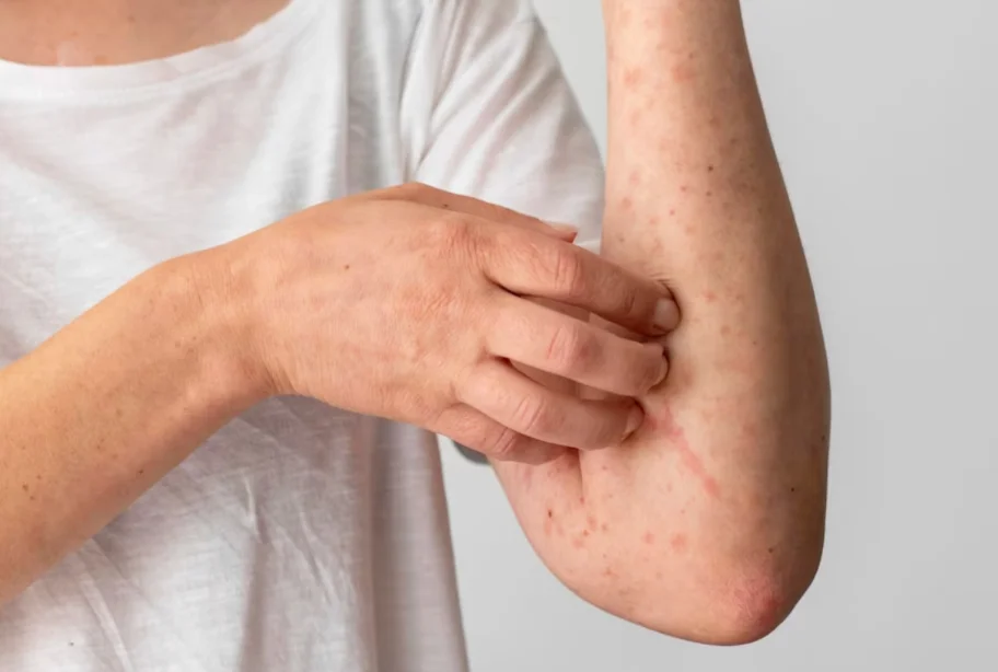 Reacción alérgica cutánea en el brazo de un hombre.