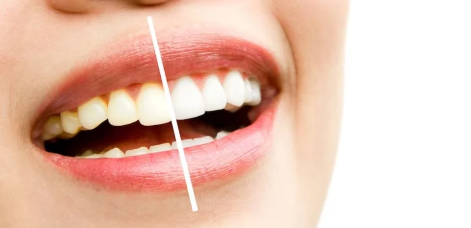 Comparativo entre dientes blancos y manchas en los dientes